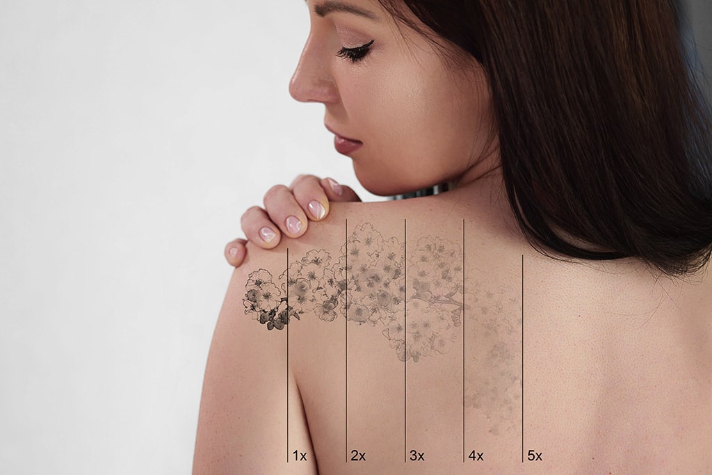 Laser tattoo removal progress showing fading stages